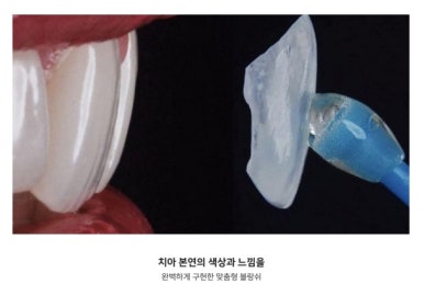 무삭제 라미네이트 vs 블랑쉬, 대표원장이 직접 알려주는 차이점 관련 이미지 12