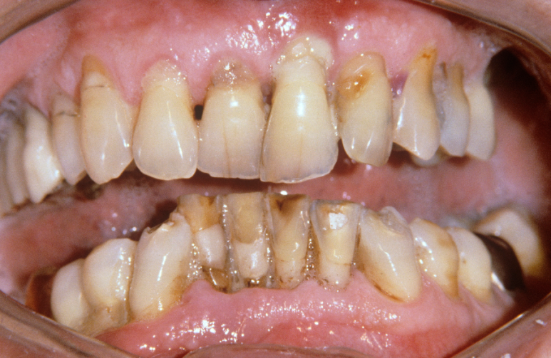 3 Easily Overlooked Causes of Gum Inflammation image 5