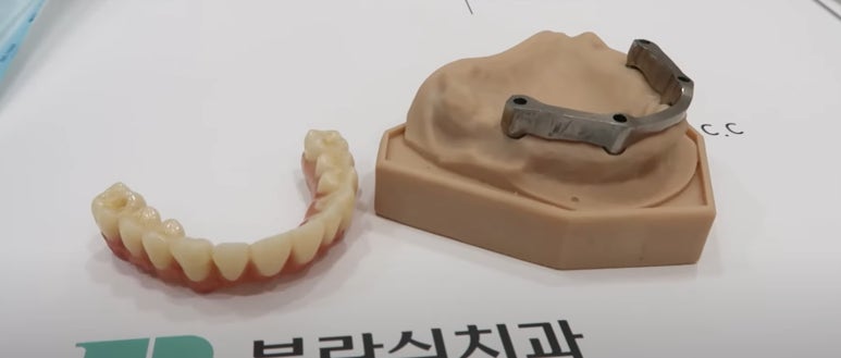 풀아치 임플란트 치과? 임플란트 결정 전 꼭 읽어보세요. 관련 이미지 11
