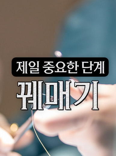 거미스마일 시술 원인 잇몸보임 구강전정술이란 관련 이미지 6