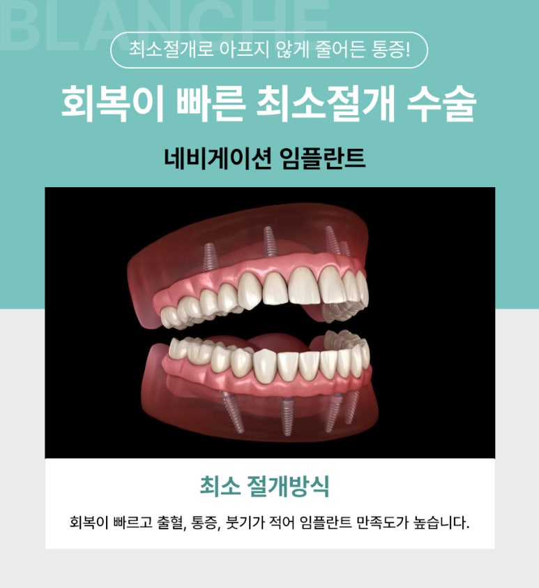 수면임플란트센터, 프리미엄 임플란트 진료는 블랑쉬치과(Blanche Dental Clinic) 관련 이미지 5