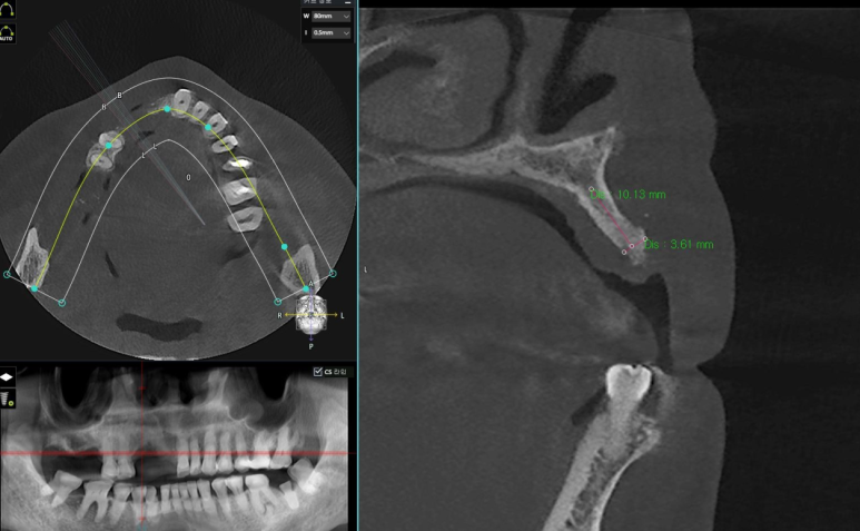 디지털 풀아치 임플란트, 틀니보다 낫다? 관련 이미지 7