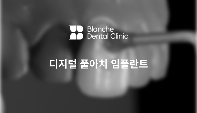 디지털 풀아치 임플란트, 틀니보다 낫다? 관련 이미지 1
