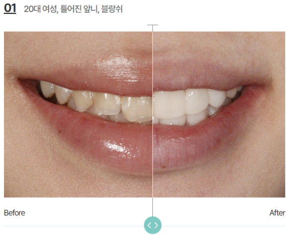 무삭제라미네이트가격, 손끝에서 결정됩니다. 관련 이미지 6