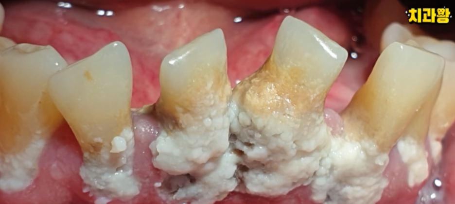 (피나는)잇몸 스케일링 방치하면 위험한 이유 관련 이미지 5