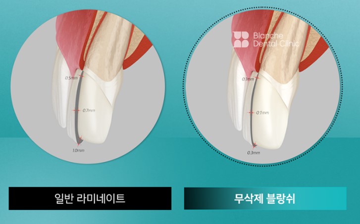 블랑쉬 부작용 문의? 관련 이미지 8