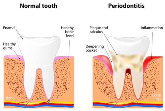 신논현치과 임플란트 뼈이식 강남 치과의사로서 솔직히 말씀드립니다. 관련 이미지 5