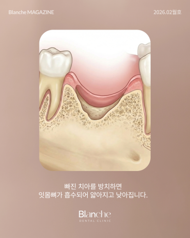 어금니 뺀 자리, 당장 안 아픈데 꼭 임플란트 해야 할까? 관련 이미지 11