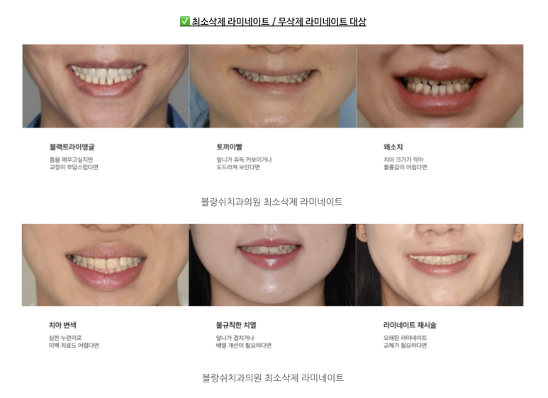 No-Prep Veneers vs. Minimal-Prep Veneers in Gangnam: How to Choose the Right Option for Your Teeth image 3