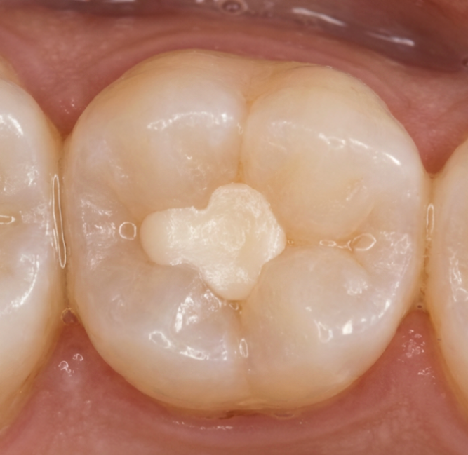 Cases Where Root Canal Treatment for Cavities Is Not Covered by National Health Insurance image 2