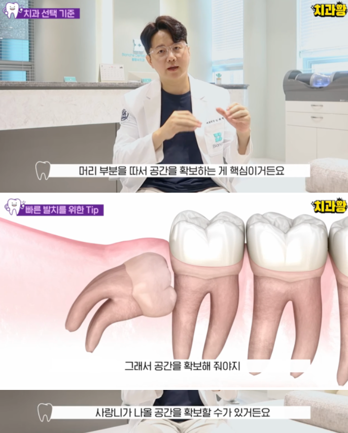 Impacted, Horizontally Positioned Wisdom Tooth Extraction: 3 Cases Where Extraction May Not Be Necessary image 4
