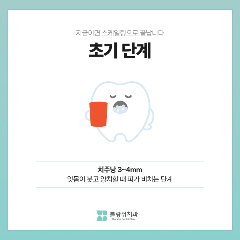 풍치 치료 초기&middot;중기&middot;말기, 단계별 치료비가 10배 차이 나는 이유 관련 이미지 5