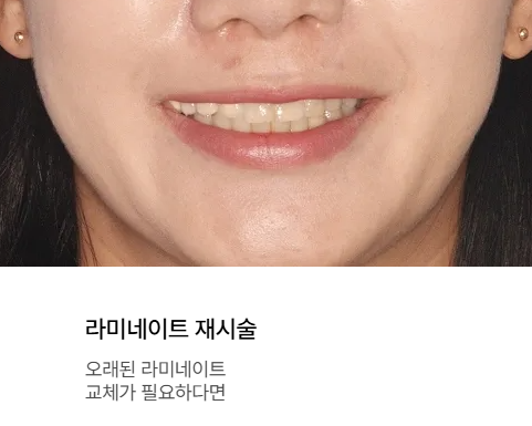 역삼동 앞니 라미네이트 재시술 붙이는 것보다 중요한 1가지 앞니마법사가 알려드림 관련 이미지 10
