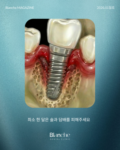 임플란트 사후관리는 어떻게?? 관련 이미지 7