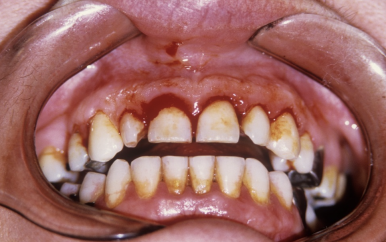 압구정 치과 50대 이후 치아 관리 이것만은 꼭 관련 이미지 3