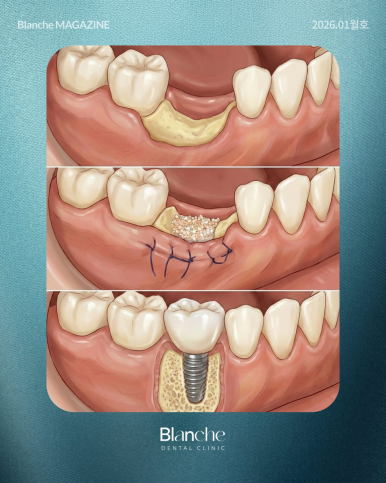 "임플란트 뼈이식, 무조건 해야 하나요?" 과잉진료 피하는 법 관련 이미지 14