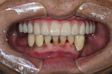 강남 풀아치 임플란트 치과, 4개로 틀니를 대체한다? 관련 이미지 6