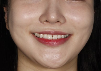 무삭제 라미네이트 부작용, 꼼꼼히 따져봐야할 핵심 관련 이미지 13