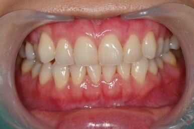 치아미백 시술 효과, 과정만큼 중요한 관리 방법 관련 이미지 3