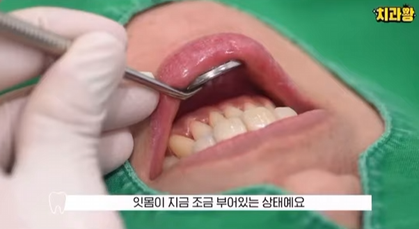 잇몸 부었을 때, 절대로 방치하면 안되는 증상 3가지 관련 이미지 2