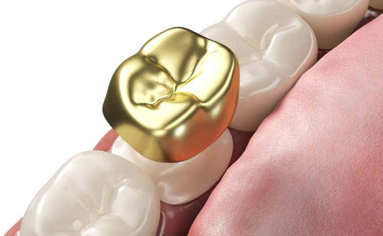 Banpo Dental Clinic: Which Crown Material Is Best Before Getting a Crown? image 3