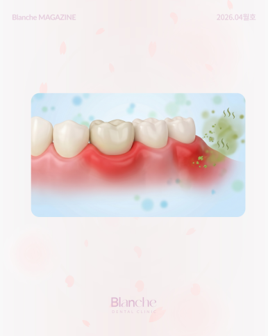Bad Breath After Laminate Veneers: Is It Normal? Causes and Solutions image 8