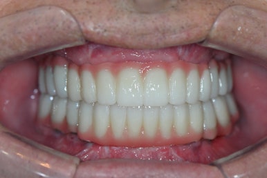 임플란트가 두렵다면 반드시 읽으세요! 관련 이미지 10