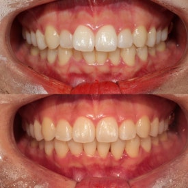 서초교정치과, 20년차 교정 전문의가 모두 대답해드립니다. <의사 작성> 관련 이미지 11
