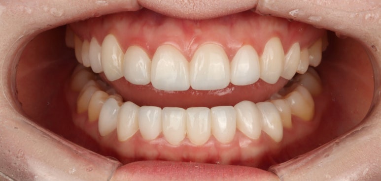 Same-Day Veneers in Korea : Cost, Process & Tips - Blanche Dental Clinic 관련 이미지 3