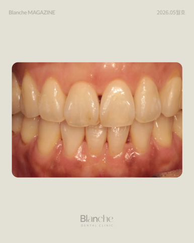 Black Gaps Between Teeth After Orthodontic Treatment image 3