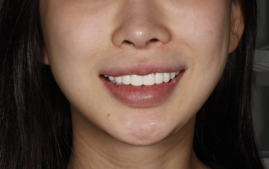 무삭제 라미네이트 추천, 핵심 정보 체크하기 관련 이미지 17