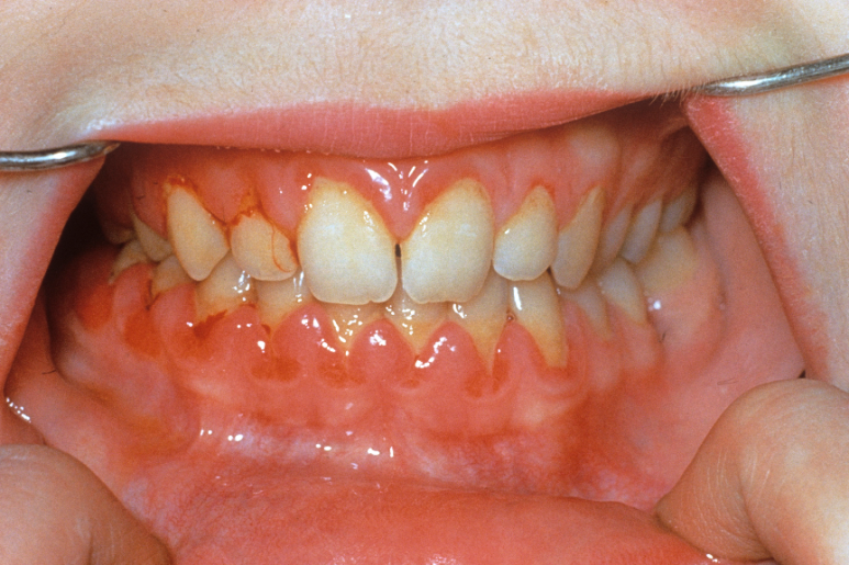 3 Easily Overlooked Causes of Gum Inflammation image 3
