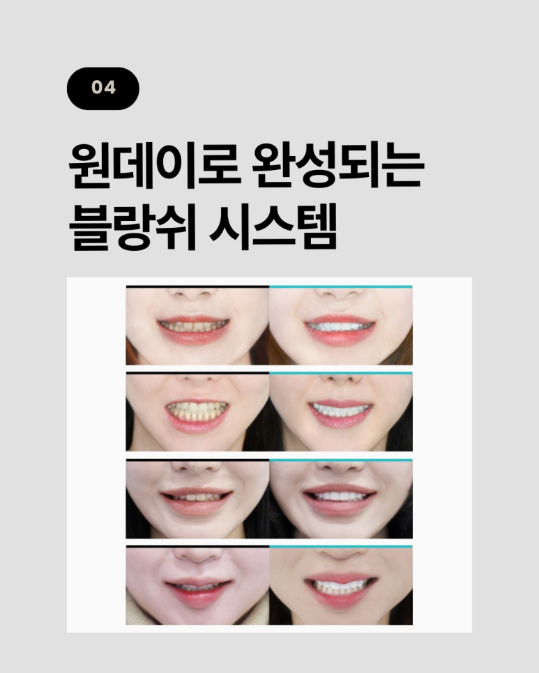 무삭제 라미네이트 vs 블랑쉬, 대표원장이 직접 알려주는 차이점 관련 이미지 13