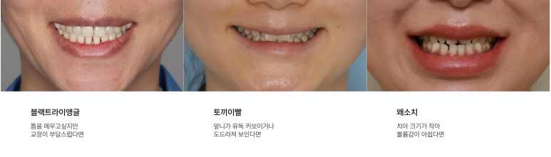 Why the Cost of No-Prep Veneers Differs by Clinic: Selection Criteria image 6