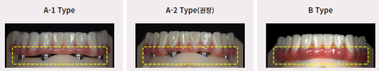 디지털 풀아치 임플란트, 틀니보다 낫다? 관련 이미지 6