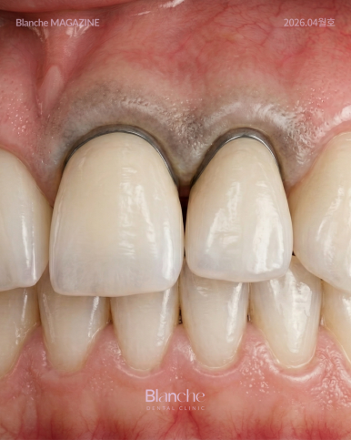 잇몸이 까맣게 변했어요! 원인별 맞춤 해결법 관련 이미지 13