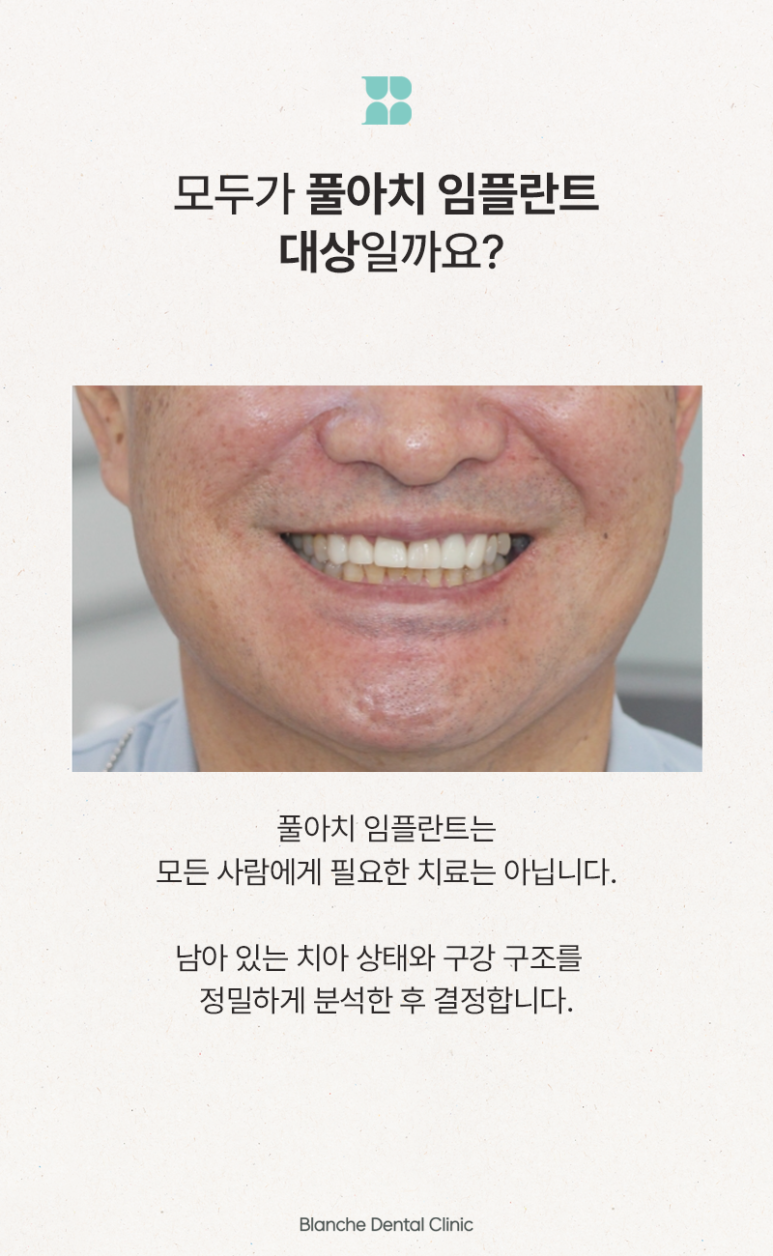 풀아치 임플란트 대상, 치료 시기와 기준을 알려드립니다 관련 이미지 4