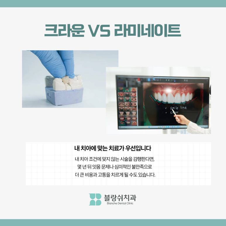 라미네이트 수명 10년? 오해와 진실 관련 이미지 3