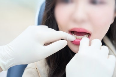 무삭제 라미네이트 후기 시간이 지나면 어떨까요? 관련 이미지 5