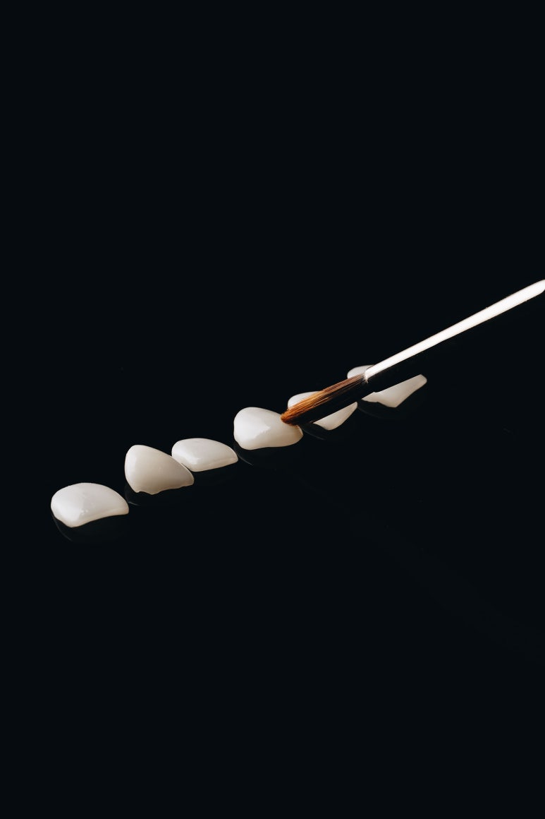 Drawbacks of No-Prep Laminate Veneers? Here’s How We Improve Them. image 8