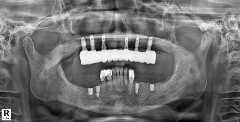강남 풀아치 임플란트 치과, 4개로 틀니를 대체한다? 관련 이미지 11