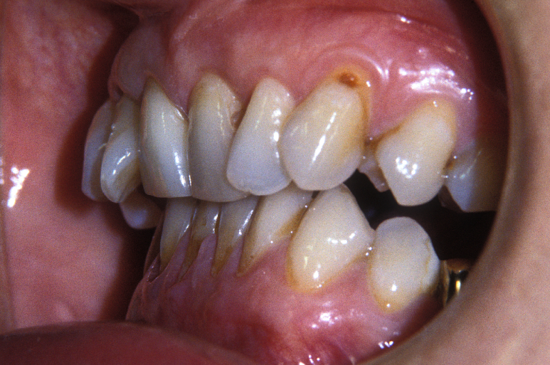 Wondering Whether You Really Need Surgery for Protruding Mouth Correction? image 2