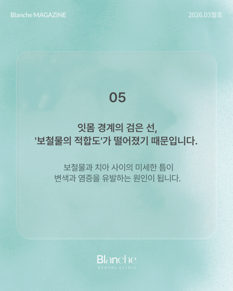 옛날에 한 라미네이트, 요즘 자꾸 신경 쓰인다면? 관련 이미지 9