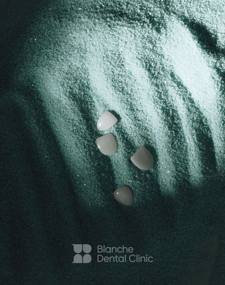 블랑쉬 라미네이트 솔루션 사례 (치아착색개선) 관련 이미지 1