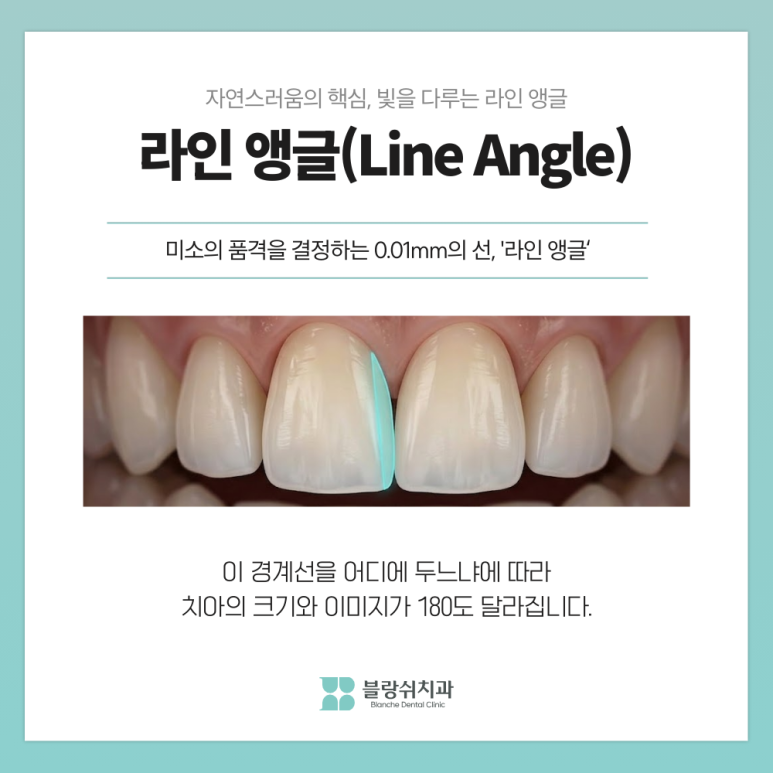 연예인 라미네이트 티 안나고 자연스러운 이유 관련 이미지 7