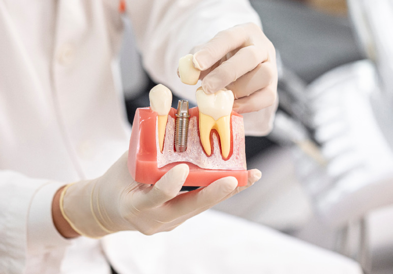 If You Hesitated Because Implant Bone Grafting Felt Frightening and Burdensome image 2