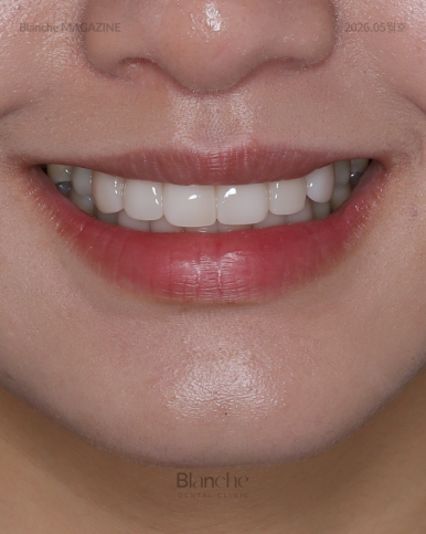 Black Gaps Between Teeth After Orthodontic Treatment image 15