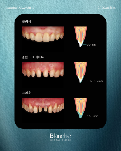 무삭제 라미네이트는 "부작용"이 없다? 관련 이미지 6