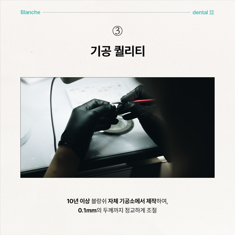 무삭제 라미네이트 부작용, 모르고 진행하면 손해보는 이유 관련 이미지 10