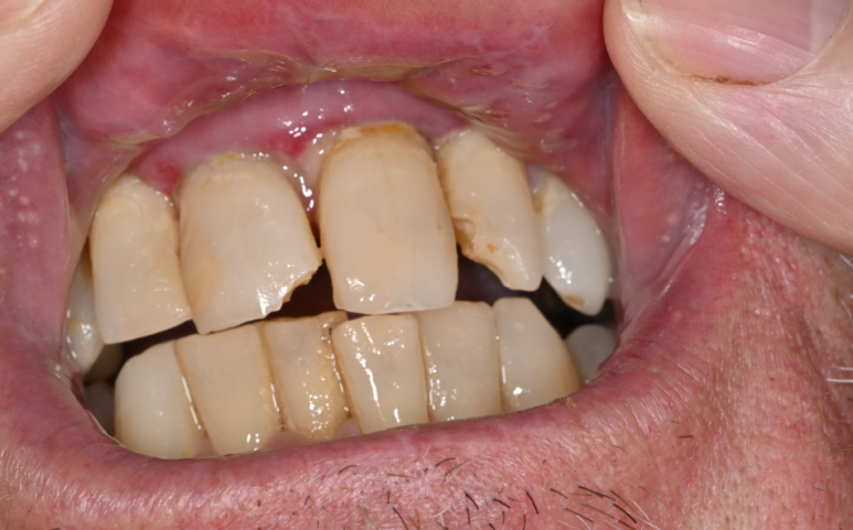 Tooth Sensitivity, Chipping, and Resin Discoloration After an InlayㅣHow to Respond to Symptoms After Cavity Treatment image 4